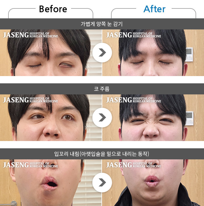 ������ڻ��ѹ溴�� ġ���� �ȸ�Ű渶�� ġ����-���� �ӹ����� ������ ����� ���� �󱼿� ���� �Ծ��.