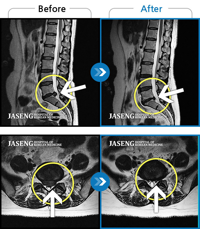 Ȼڻѹ溴 ġ MRI  ġ- ڼ  ӵǾ.