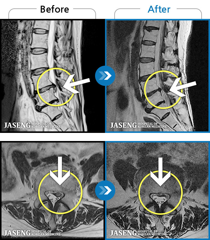 �ϻ��ڻ��ѹ溴�� ġ���� MRI�� ���� ġ����-�㸮, ���� ��ݺ��� ���� �ٸ��� ���� �� ������ ���ӵǰ� ���� �ٸ��� ������ ����