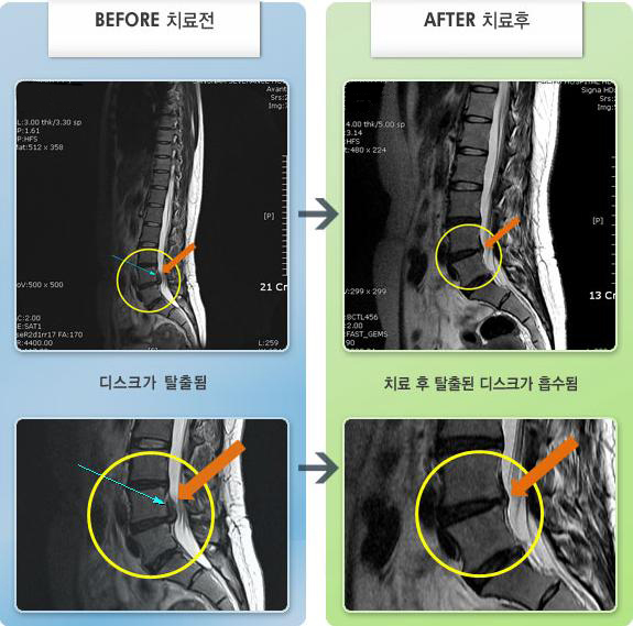 자생한방병원 치료사례 MRI로 보는 치료결과-1996년 L5 부위 수술하였으나 2010. 6월 재발