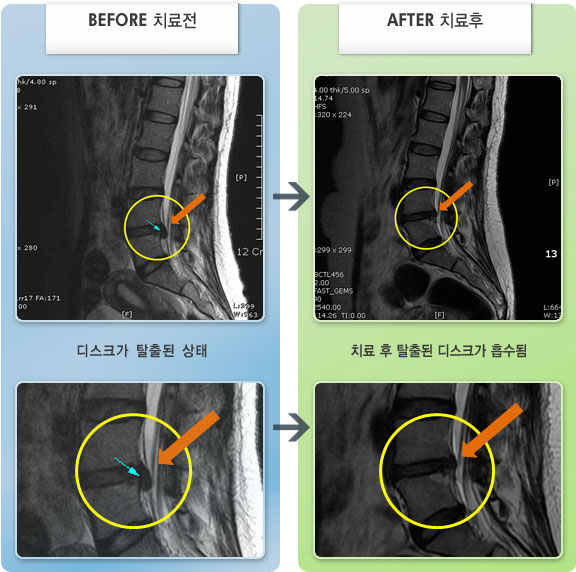 자생한방병원 치료사례 MRI로 보는 치료결과-허리 통증 및 우측 오금이 수시로 당기는 통증