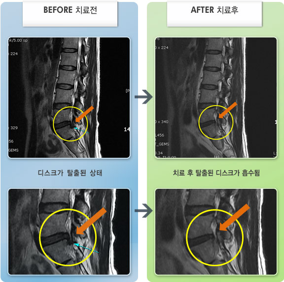자생한방병원 치료사례 MRI로 보는 치료결과-허리와 좌하지 통증이 심하여 지속적인 좌하지 방사통으로 앉아있기도 힘든 상태