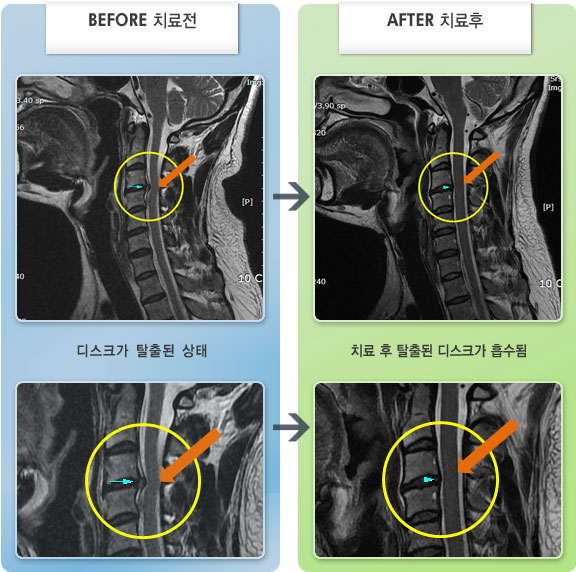 자생한방병원 치료사례 MRI로 보는 치료결과-후경부 및 우측 승모근 통증이 심하여 목의 움직임이 제한된 상태
