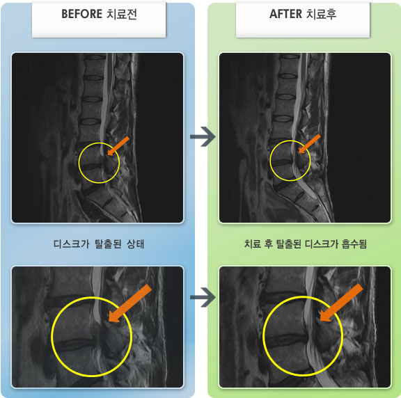 자생한방병원 치료사례 MRI로 보는 치료결과-허리의 통증이 심하여 전반적인 움직임이 제한된 상태