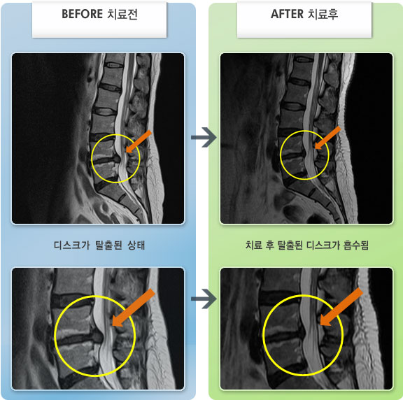 자생한방병원 치료사례 MRI로 보는 치료결과-왼쪽 다리 당기고 앉았다 일어날 때 통증이 증가