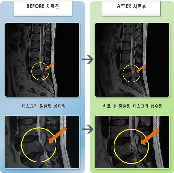 자생한방병원 치료사례 MRI로 보는 치료결과-허리디스크로 인한 왼쪽 엉치 및 종아리 저림