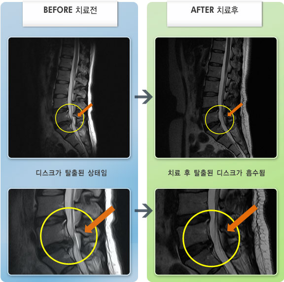 자생한방병원 치료사례 MRI로 보는 치료결과-허리의 통증이 심하여 전반적인 움직임이 자유롭지 못했다.