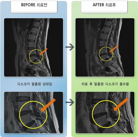 자생한방병원 치료사례 MRI로 보는 치료결과-허리디스크로 인한 좌측 엉치, 종아리, 발등 저림 증상