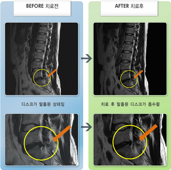 자생한방병원 치료사례 MRI로 보는 치료결과-허리디스크로 인한 좌측 둔부 및 대퇴부 통증